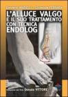 L' alluce valgo e il suo trattamento con tecnica endolog