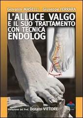 L' alluce valgo e il suo trattamento con tecnica endolog